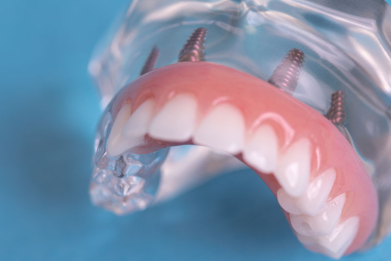 clear jaw structure with 4 implants in it and a full set of teeth to pair
