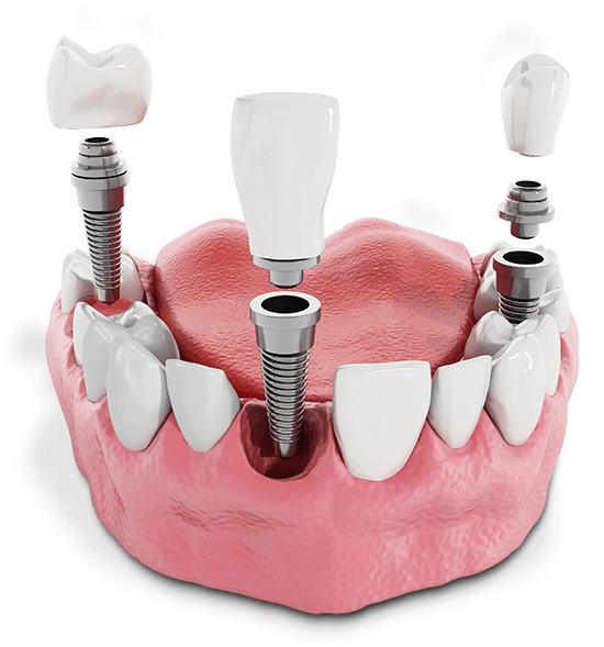 multiple single implants for teeth being places with the different portions having seperation so you can see the structure