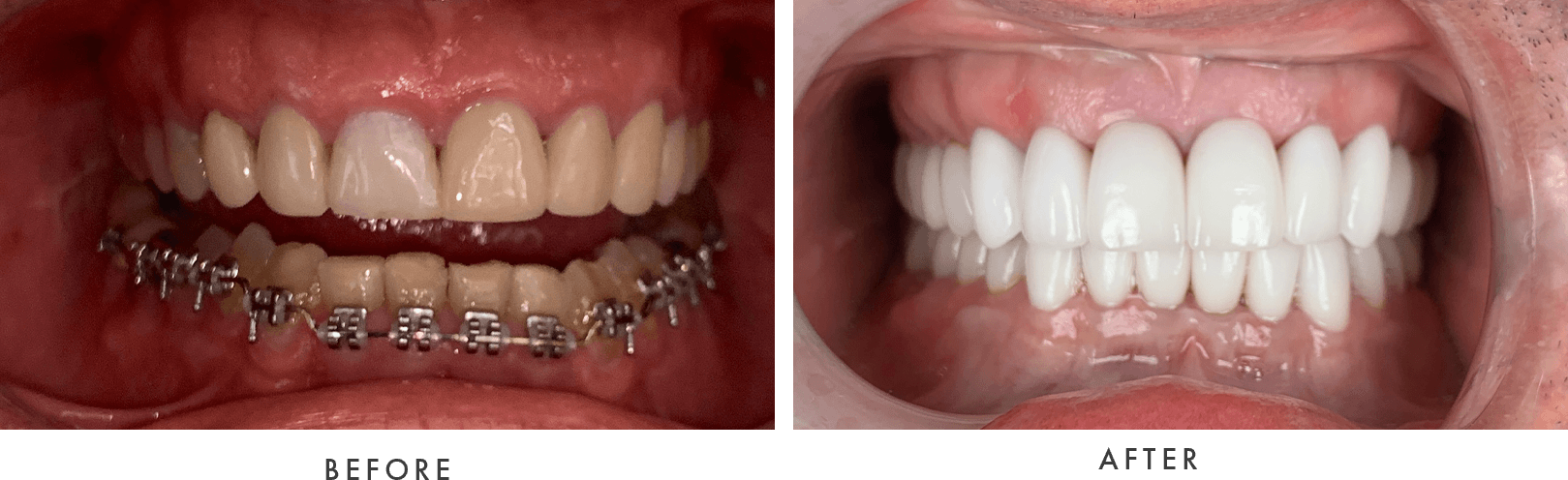 braces before and after