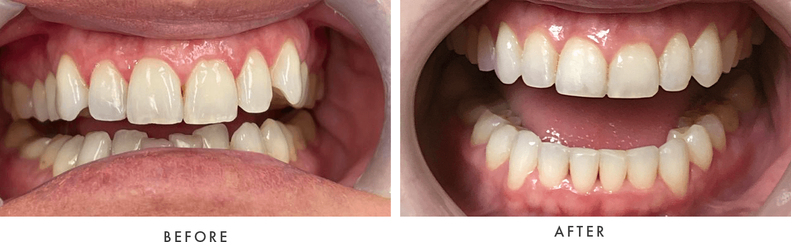 cosmetic dentistry before and after