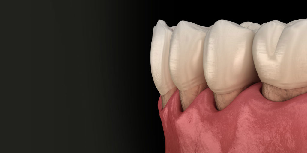 gum recession graphic