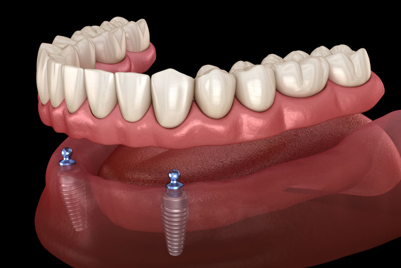 implant supported dentures graphic