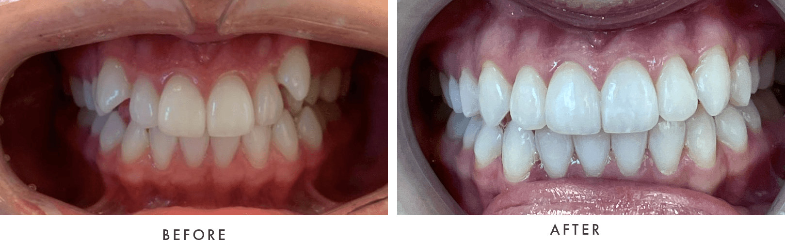 Invisalign before and after