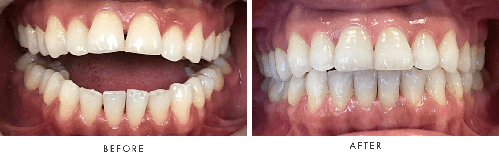 Invisalign before and after