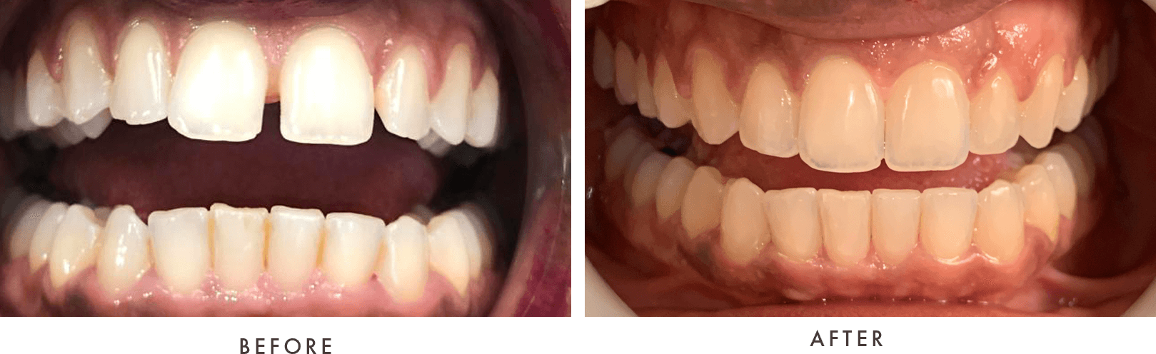 Invisalign before and after