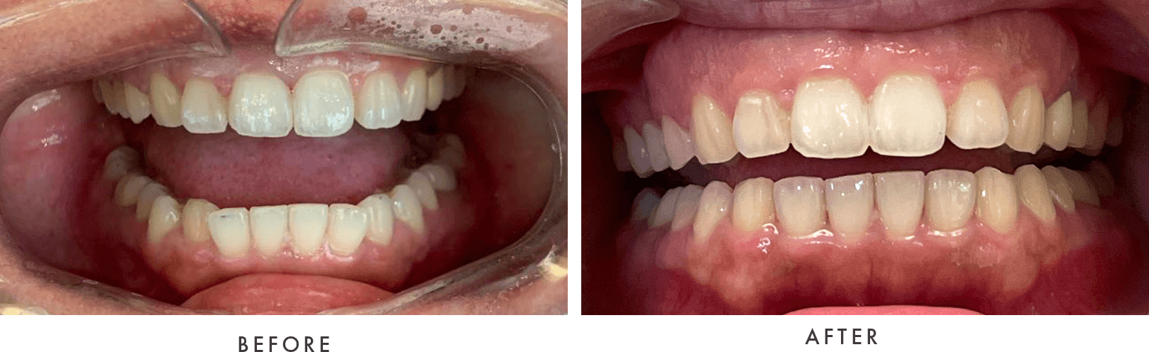 Invisalign before and after