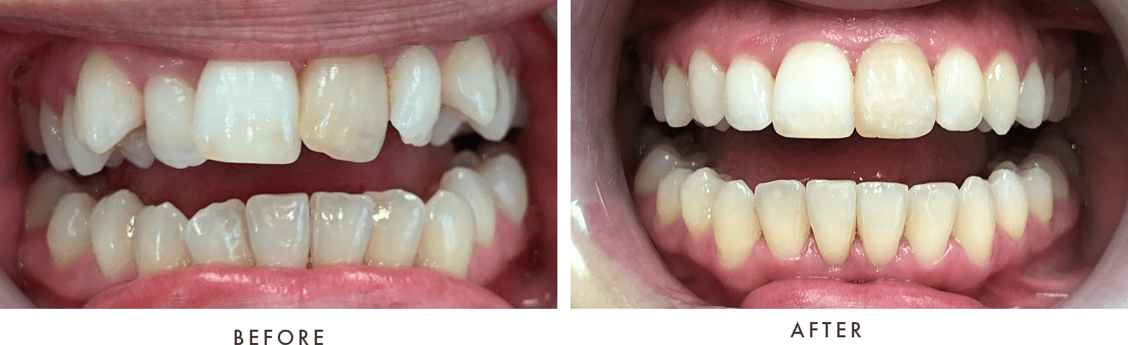 Invisalign before and after