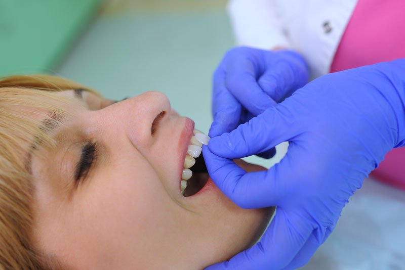 a dental veneer patient getting new porcelain veneers placed