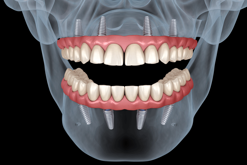 all-on-4 full mouth dental implant digital smile preview