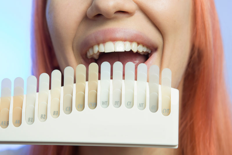 a dental patient smiling after recieving new dental veneers