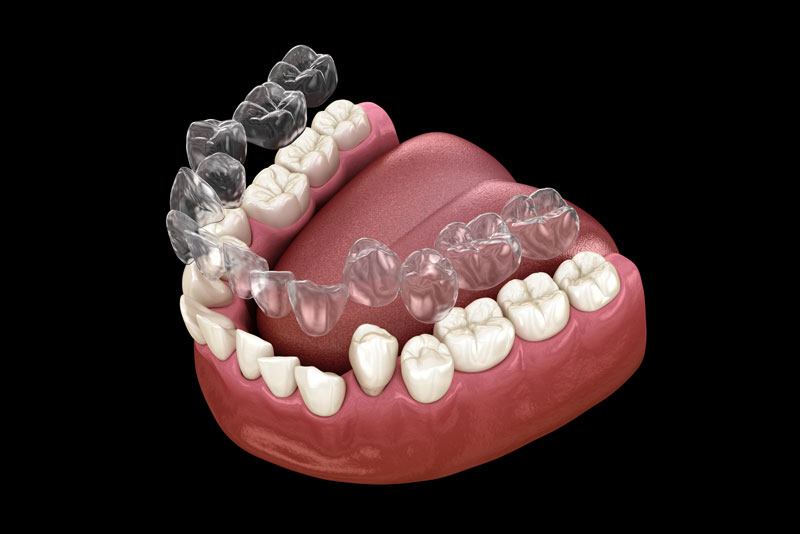 A graphic image of a lower arch dental implant model with an Invisalign clear aligner hovering over the teeth so it can be placed and straighten them.