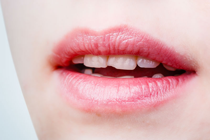 A photo of a patients partially opened mouth, showing upper arch teeth that are in need of dental veneers.