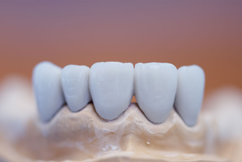 a monolithic dental bridge model.