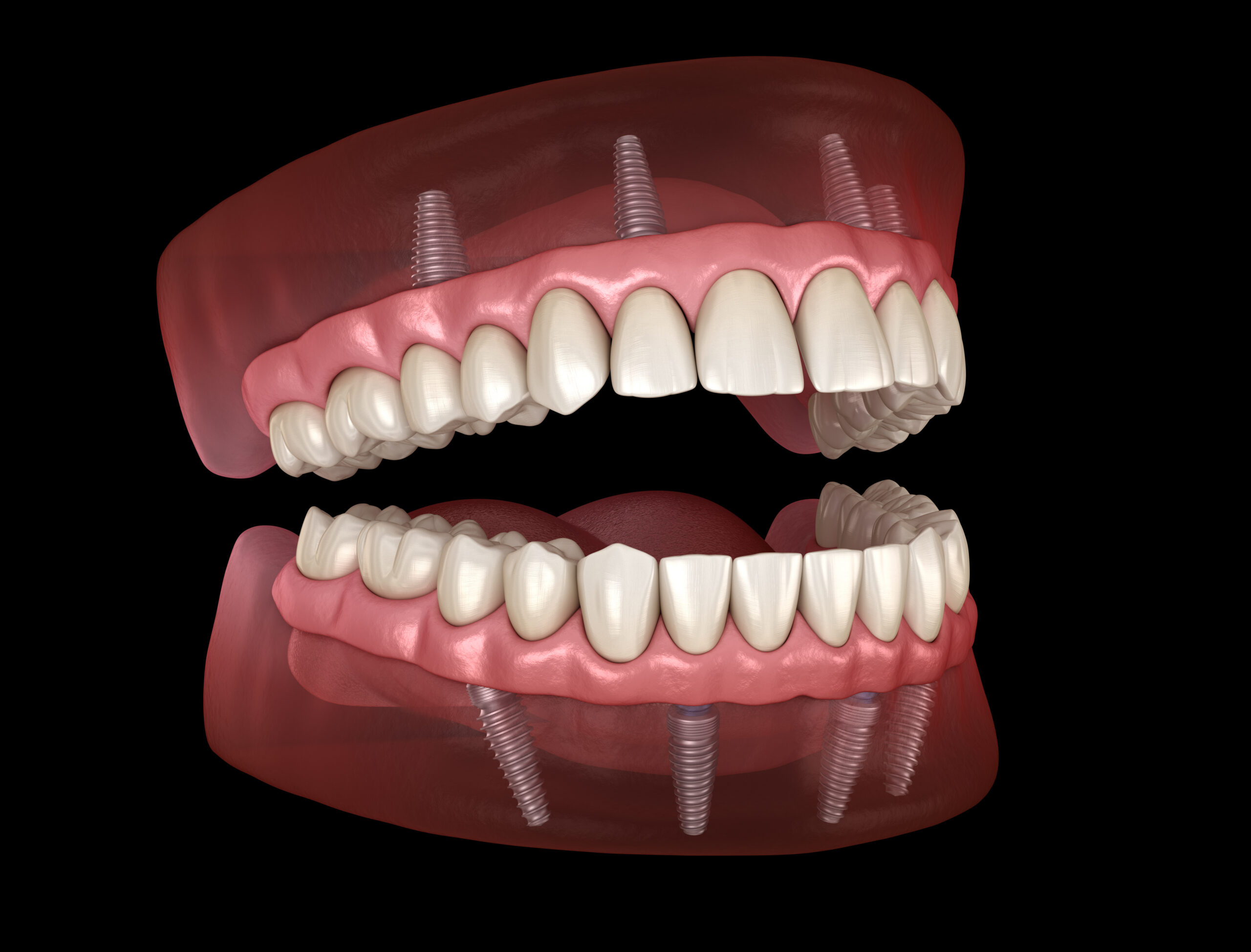 full mouth dental implants 3D model in Mission Viejo, CA.