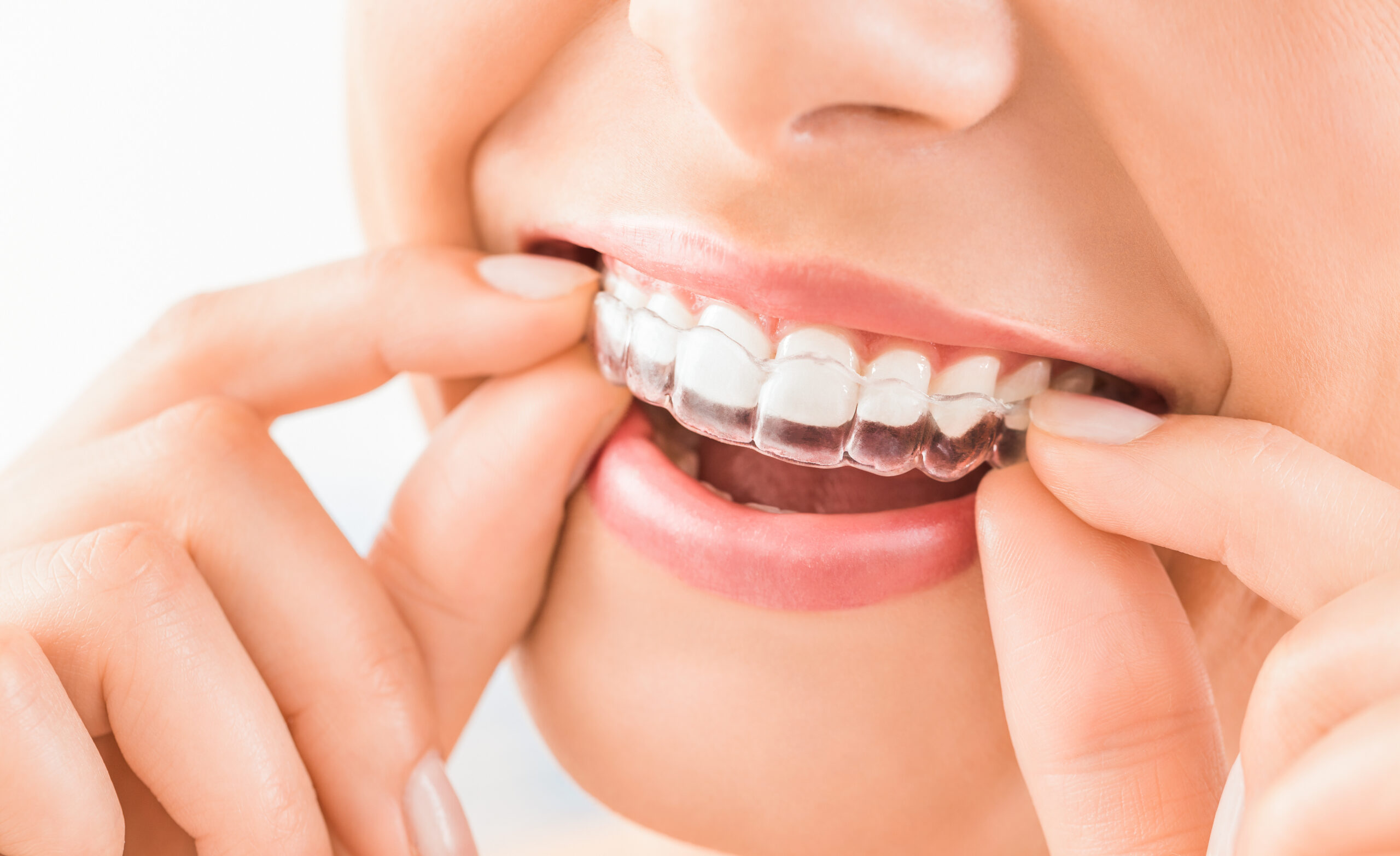 How Do Invisalign® Clear Aligners In Mission Viejo, CA Improve My Smile?