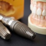Photo of implant and tooth model