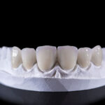 Dental veneers on an upper jaw model; laying on a black reflective table