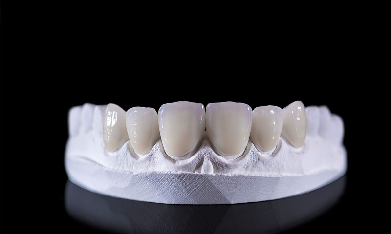 Dental veneers on an upper jaw model; laying on a black reflective table