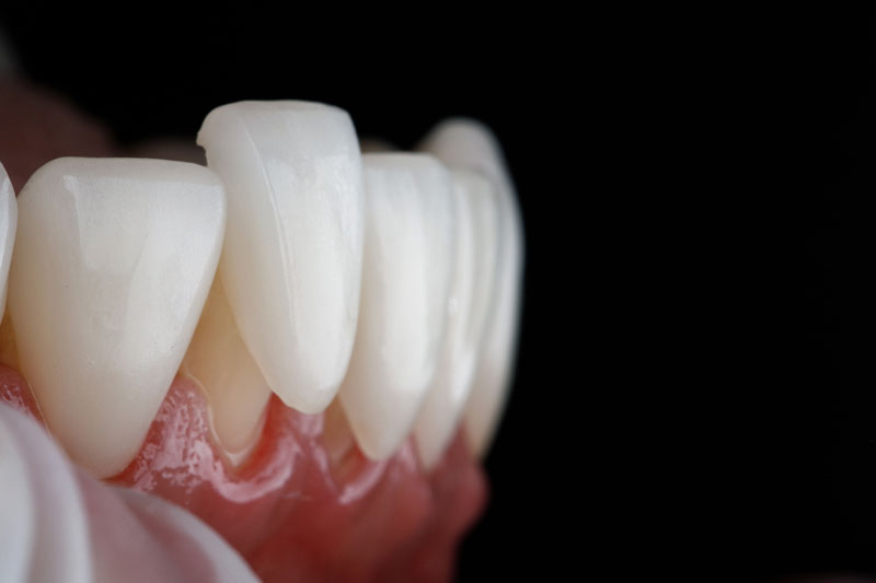 a porcelain veneer being placed on top of a tooth