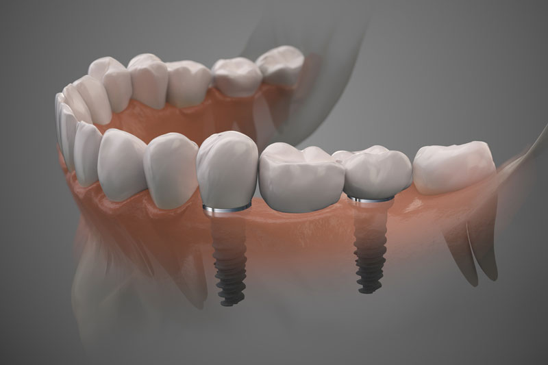 2 single dental implants with 2 crowns that go on top of each of them